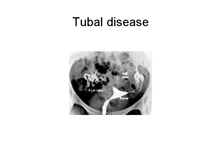 Tubal disease 