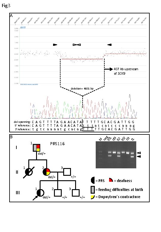 Fig 3 A 407 kb upstream of SOX 9 deletion = 6031 bp del-spanning: