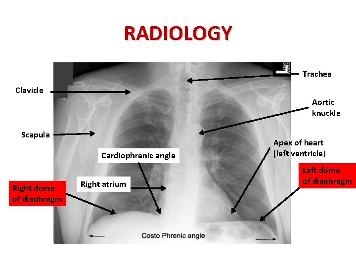 RADIOLOGY Trachea Clavicle Aortic knuckle Scapula Cardiophrenic angle Right dome of diaphragm Right atrium
