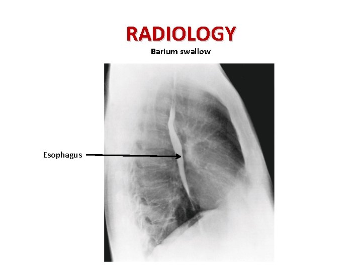 RADIOLOGY Barium swallow Esophagus 
