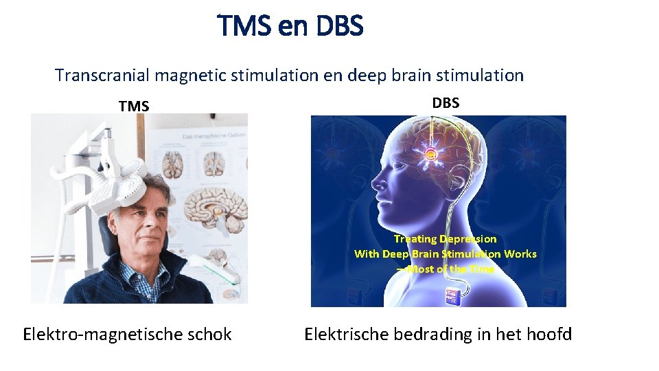 TMS en DBS Transcranial magnetic stimulation en deep brain stimulation TMS DBS Treating Depression