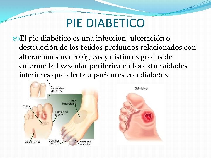 PIE DIABETICO El pie diabético es una infección, ulceración o destrucción de los tejidos