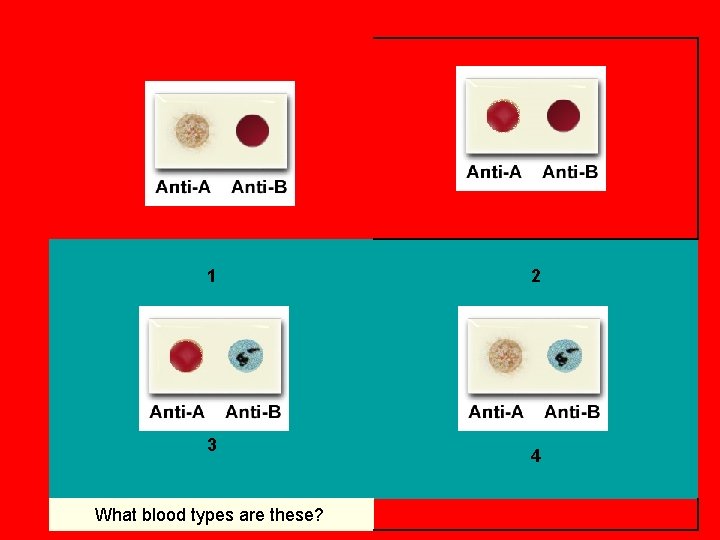 1 2 Examine the slides below and determine the blood type of the subject