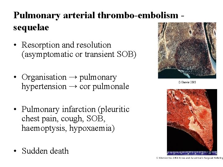 Pulmonary arterial thrombo-embolism sequelae • Resorption and resolution (asymptomatic or transient SOB) • Organisation