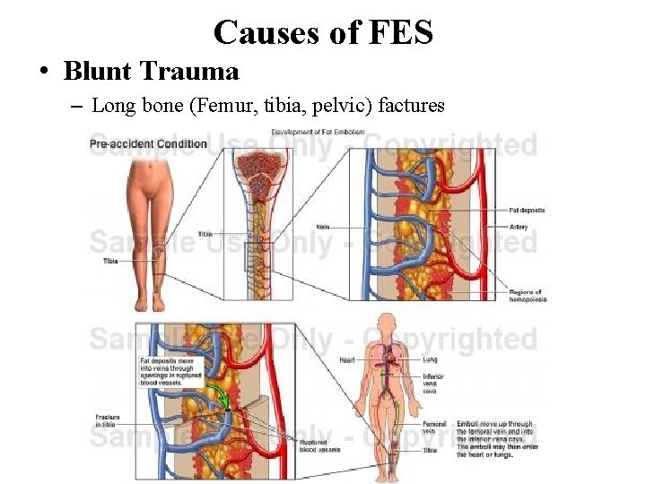 Causes of FES • Blunt Trauma – Long bone (Femur, tibia, pelvic) factures 