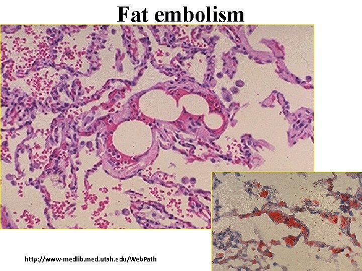 Fat embolism http: //www-medlib. med. utah. edu/Web. Path 