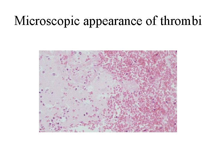 Microscopic appearance of thrombi 