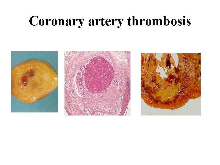 Coronary artery thrombosis 