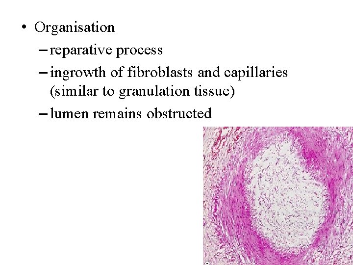  • Organisation – reparative process – ingrowth of fibroblasts and capillaries (similar to