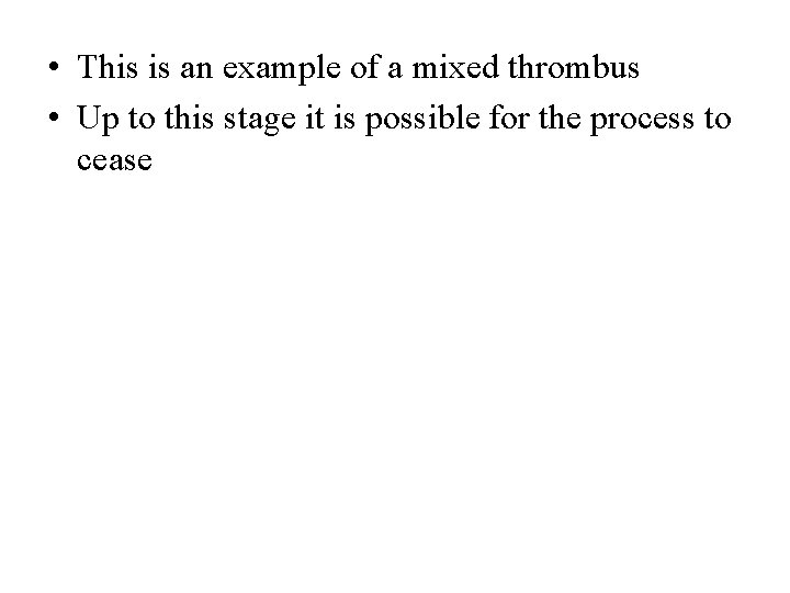  • This is an example of a mixed thrombus • Up to this