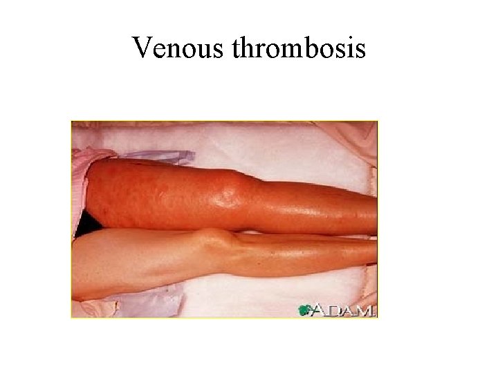 Venous thrombosis 