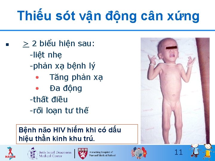 Thiếu sót vận động cân xứng n > 2 biểu hiện sau: -liệt nhẹ