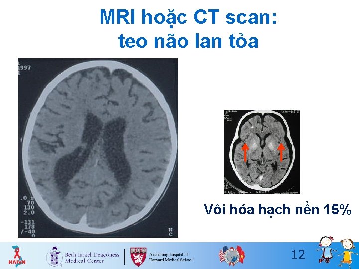 MRI hoặc CT scan: teo não lan tỏa Vôi hóa hạch nền 15% 12