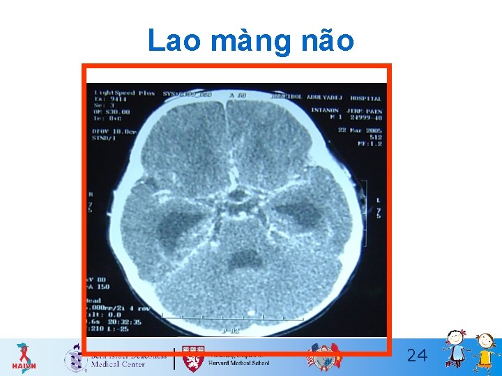 Lao màng não 24 