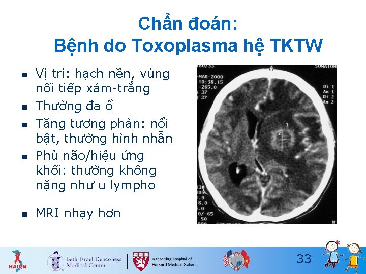 Chẩn đoán: Bệnh do Toxoplasma hệ TKTW n n n Vị trí: hạch nền,