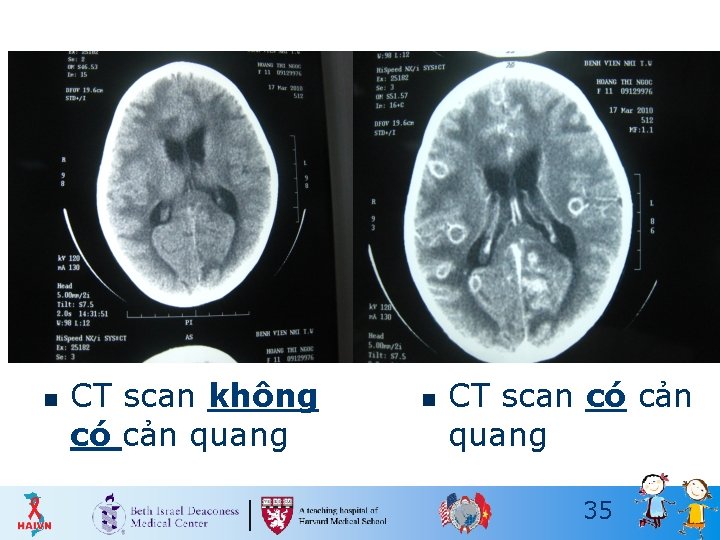 n CT scan không có cản quang n CT scan có cản quang 35