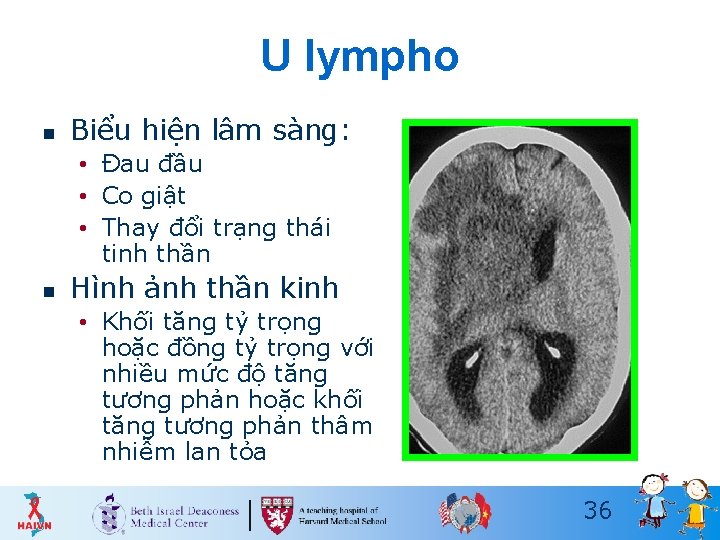 U lympho n Biểu hiện lâm sàng: • Đau đầu • Co giật •