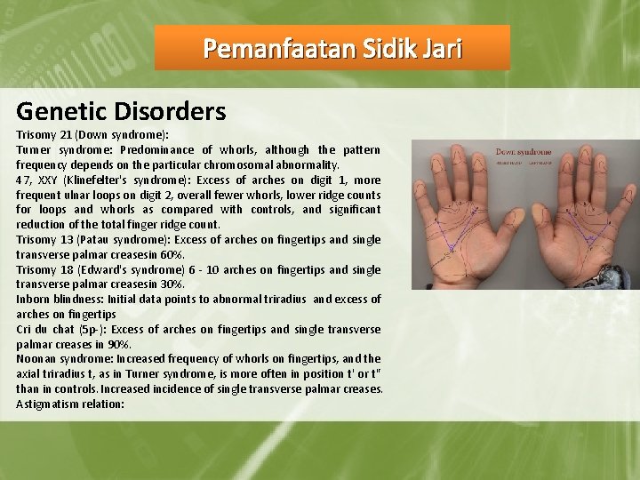 Pemanfaatan Sidik Jari Genetic Disorders Trisomy 21 (Down syndrome): Turner syndrome: Predominance of whorls,