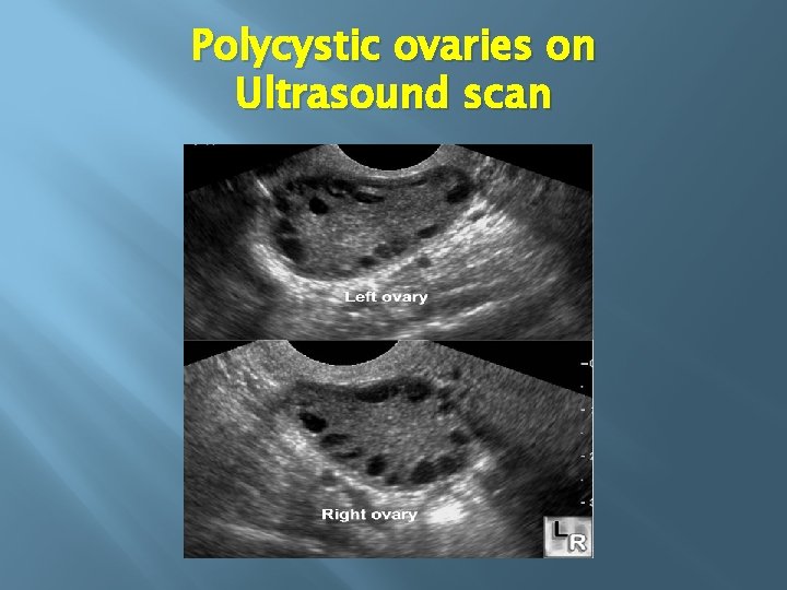 Polycystic ovaries on Ultrasound scan 