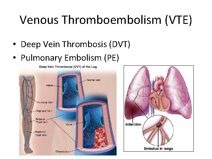 Venous Thromboembolism (VTE) • Deep Vein Thrombosis (DVT) • Pulmonary Embolism (PE) 