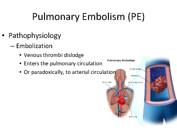 Pulmonary Embolism (PE) • Pathophysiology – Embolization • Venous thrombi dislodge • Enters the