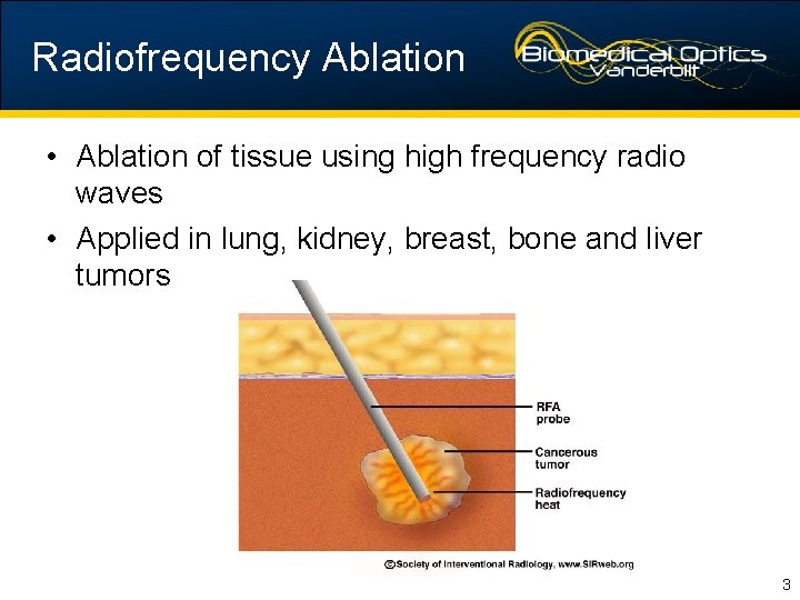 Radiofrequency Ablation • Ablation of tissue using high frequency radio waves • Applied in