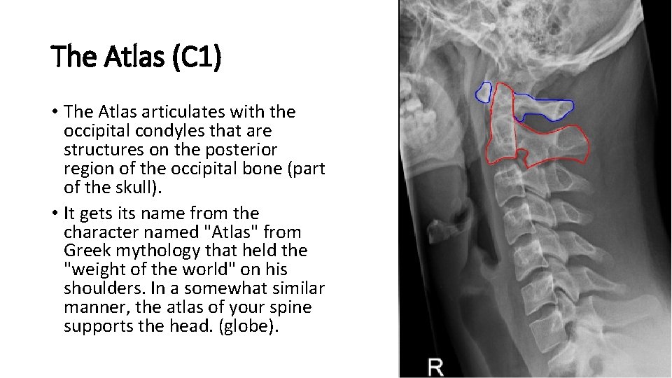 The Atlas (C 1) • The Atlas articulates with the occipital condyles that are