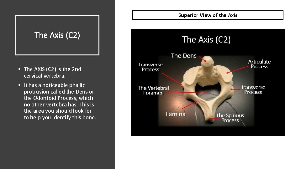 Superior View of the Axis The Axis (C 2) • The AXIS (C 2)