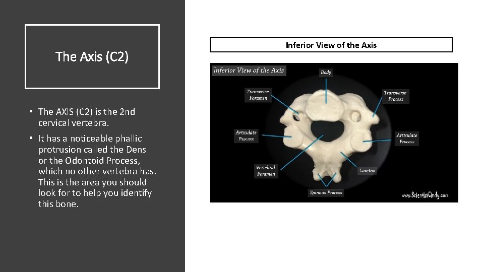 The Axis (C 2) • The AXIS (C 2) is the 2 nd cervical