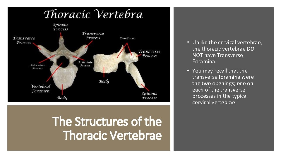  • Unlike the cervical vertebrae, the thoracic vertebrae DO NOT have Transverse Foramina.