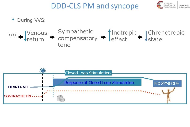 DDD-CLS PM and syncope • VV During VVS: Venous return Sympathetic compensatory tone Inotropic