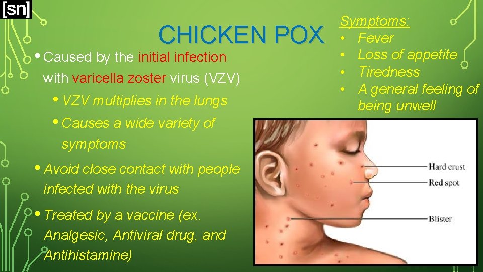 CHICKEN POX • Caused by the initial infection with varicella zoster virus (VZV) •