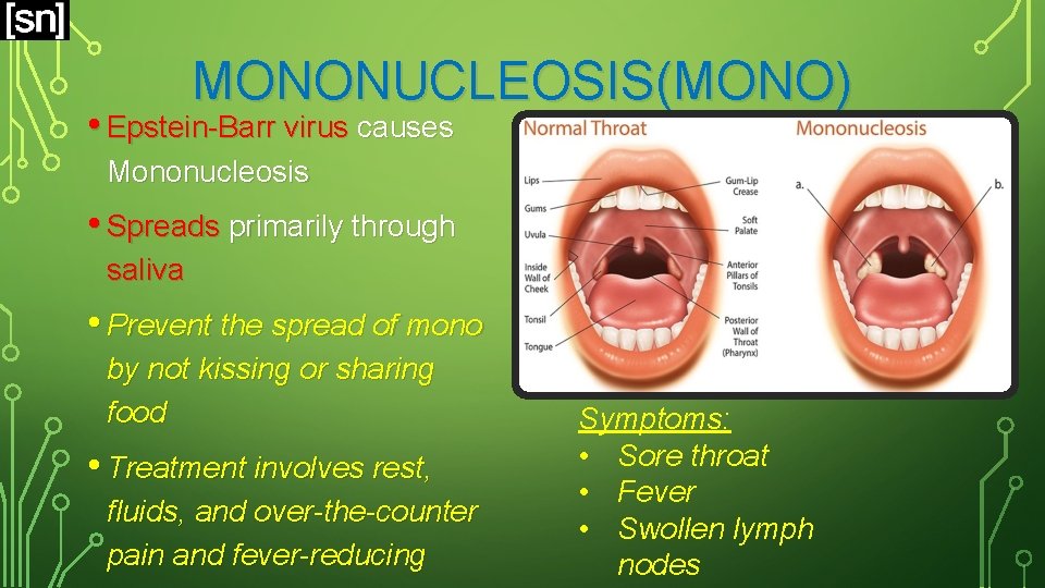 MONONUCLEOSIS(MONO) • Epstein-Barr virus causes Mononucleosis • Spreads primarily through saliva • Prevent the