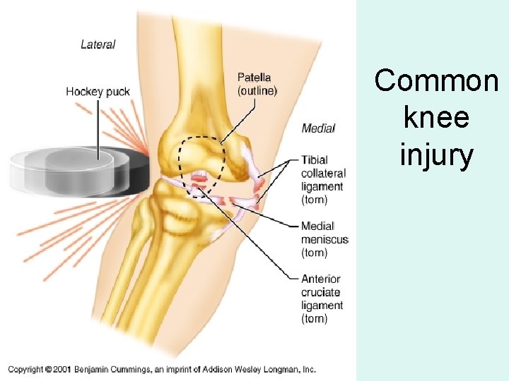 Common knee injury 