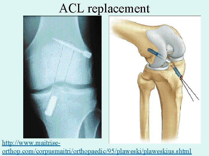 ACL replacement http: //www. maitriseorthop. com/corpusmaitri/orthopaedic/95/plaweskius. shtml 