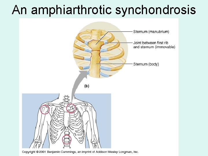 An amphiarthrotic synchondrosis An amphiarthrotic synchondrosis