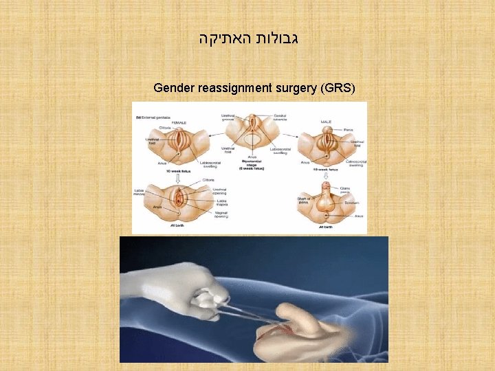  גבולות האתיקה Gender reassignment surgery (GRS) 