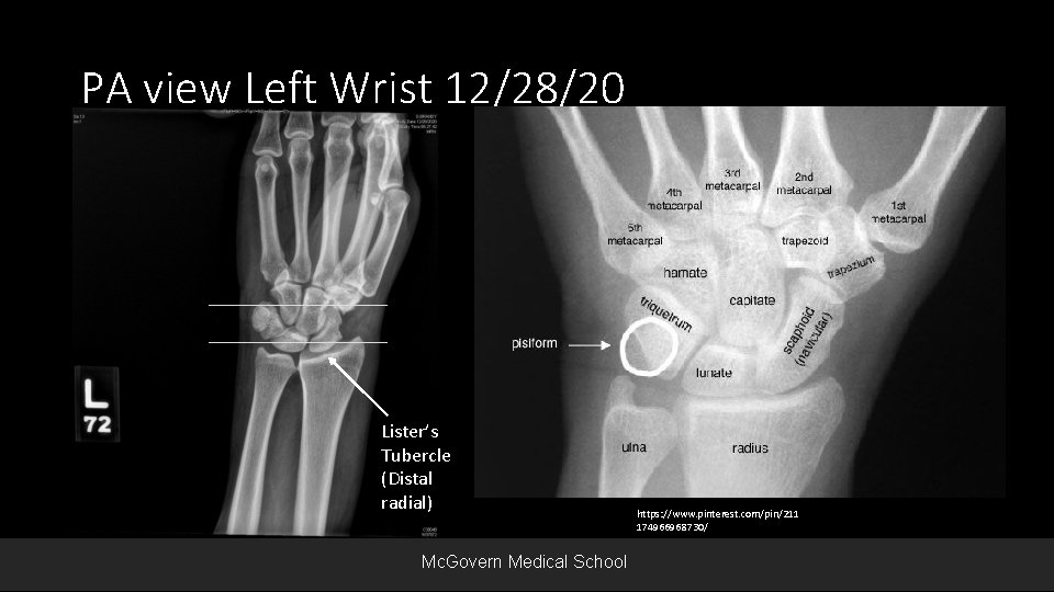 PA view Left Wrist 12/28/20 Lister’s Tubercle (Distal radial) Mc. Govern Medical School https: