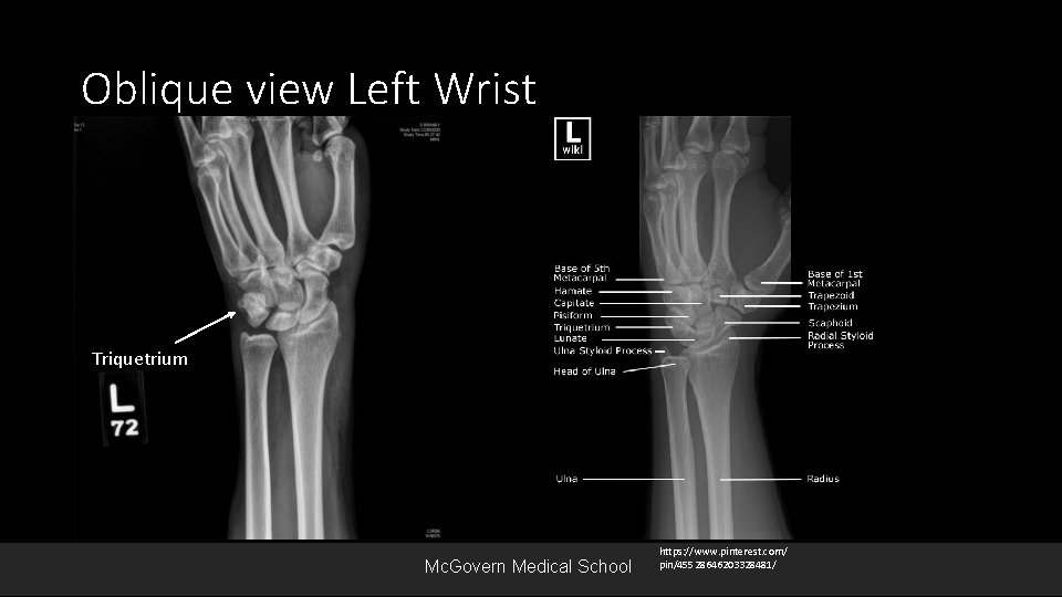 Oblique view Left Wrist Triquetrium Mc. Govern Medical School https: //www. pinterest. com/ pin/45528646203328481/