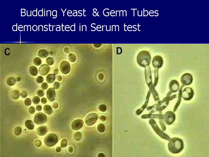 Budding Yeast & Germ Tubes demonstrated in Serum test 