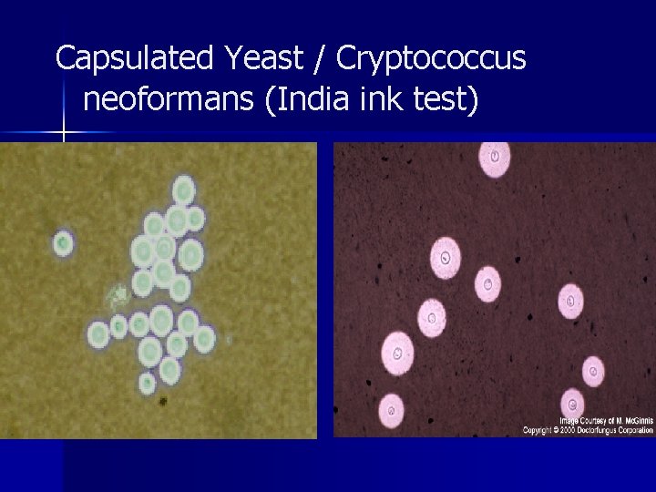 Capsulated Yeast / Cryptococcus neoformans (India ink test) 