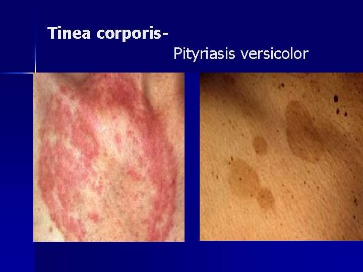 Tinea corporis. Pityriasis versicolor 