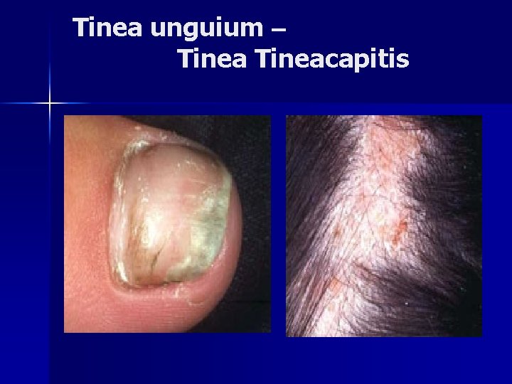 Tinea unguium – Tineacapitis 