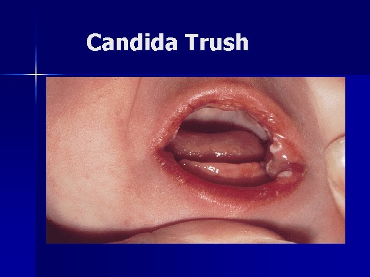 Candida Trush 
