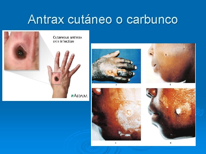 Antrax cutáneo o carbunco 