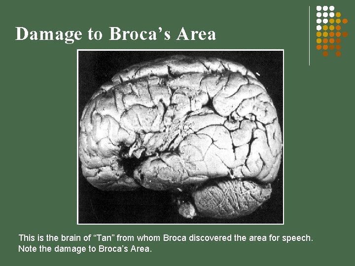 Damage to Broca’s Area This is the brain of “Tan” from whom Broca discovered