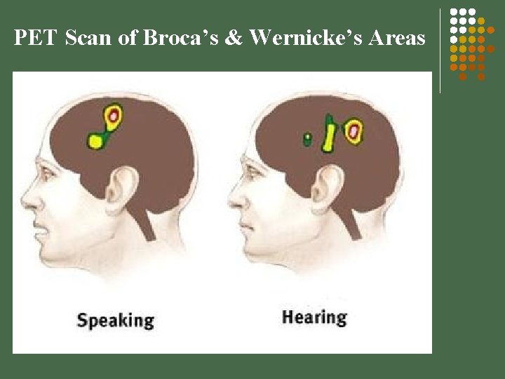 PET Scan of Broca’s & Wernicke’s Areas 