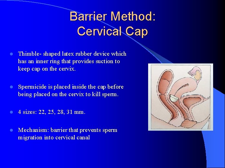Barrier Method: Cervical Cap l Thimble- shaped latex rubber device which has an inner