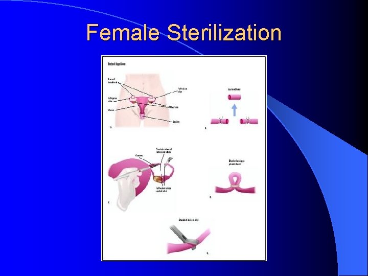 Female Sterilization 