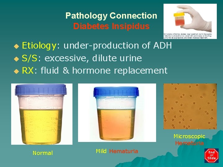 Pathology Connection Diabetes Insipidus Etiology: under-production of ADH u S/S: excessive, dilute urine u